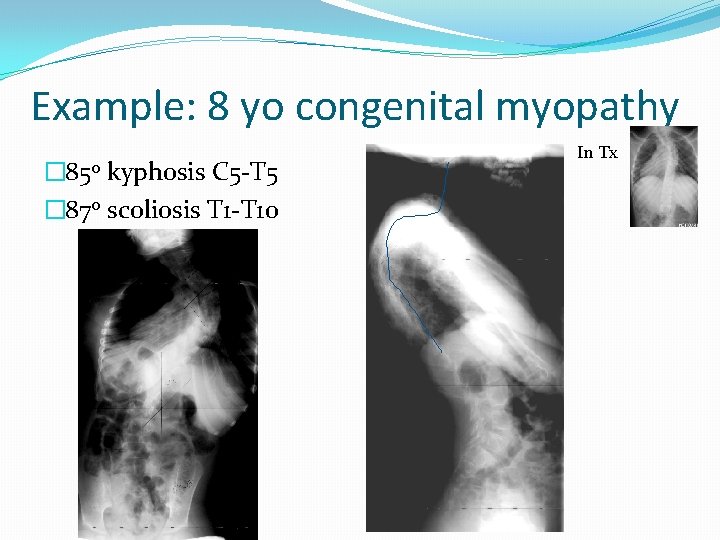 Example: 8 yo congenital myopathy � 85 o kyphosis C 5 -T 5 �