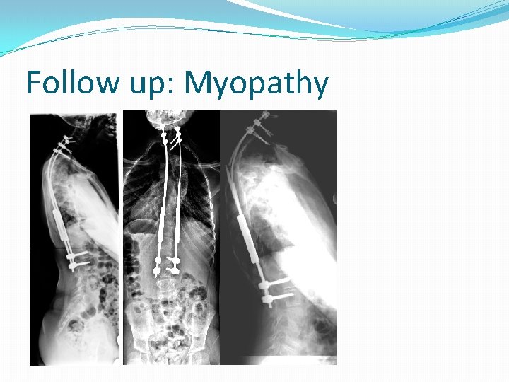 Follow up: Myopathy 