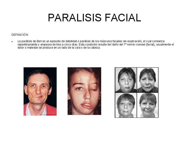 PARALISIS FACIAL DEFINICIÓN La parálisis de Bell es un episodio de debilidad o parálisis PARALISIS FACIAL DEFINICIÓN La parálisis de Bell es un episodio de debilidad o parálisis