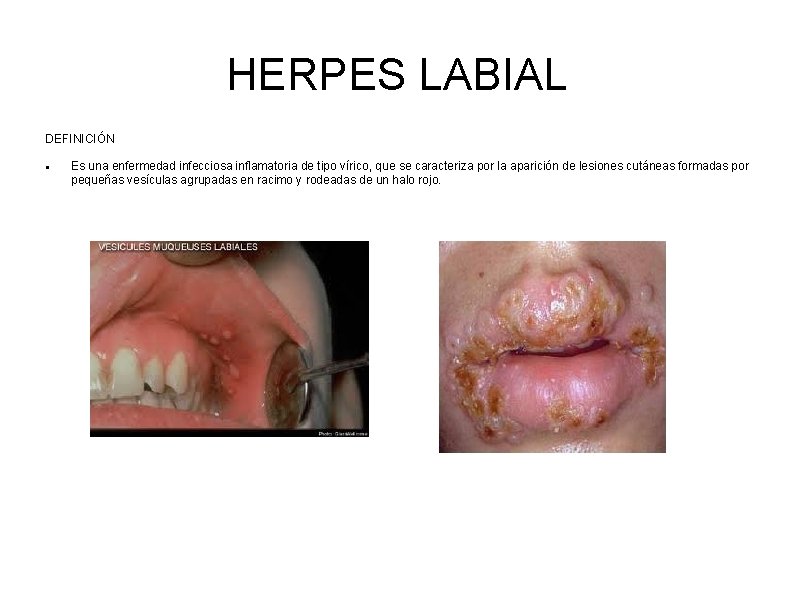 HERPES LABIAL DEFINICIÓN Es una enfermedad infecciosa inflamatoria de tipo vírico, que se caracteriza