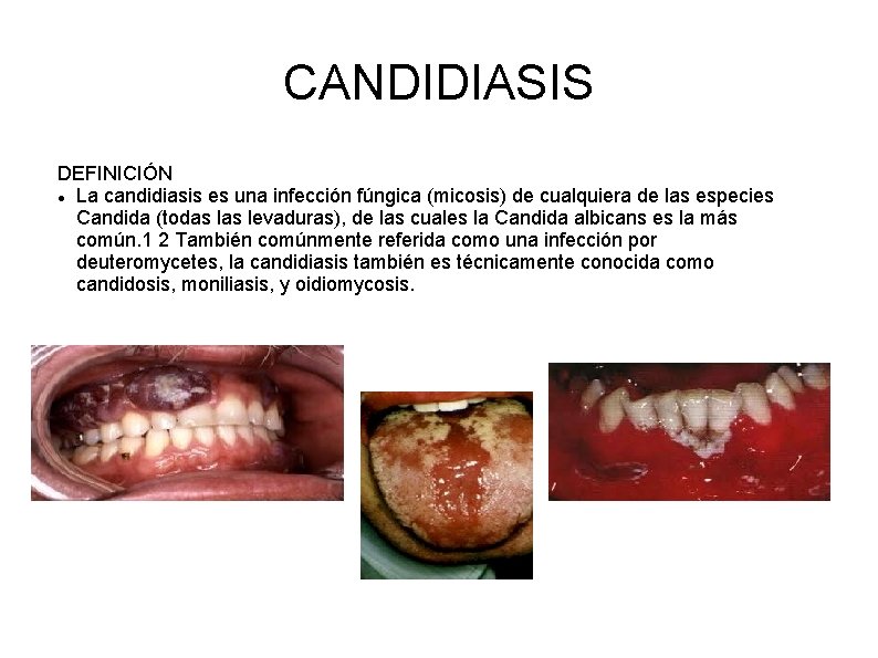 CANDIDIASIS DEFINICIÓN La candidiasis es una infección fúngica (micosis) de cualquiera de las especies