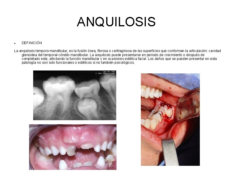 ANQUILOSIS DEFINICIÓN La anquilosis temporo-mandibular, es la fusión ósea, fibrosa o cartilaginosa de las