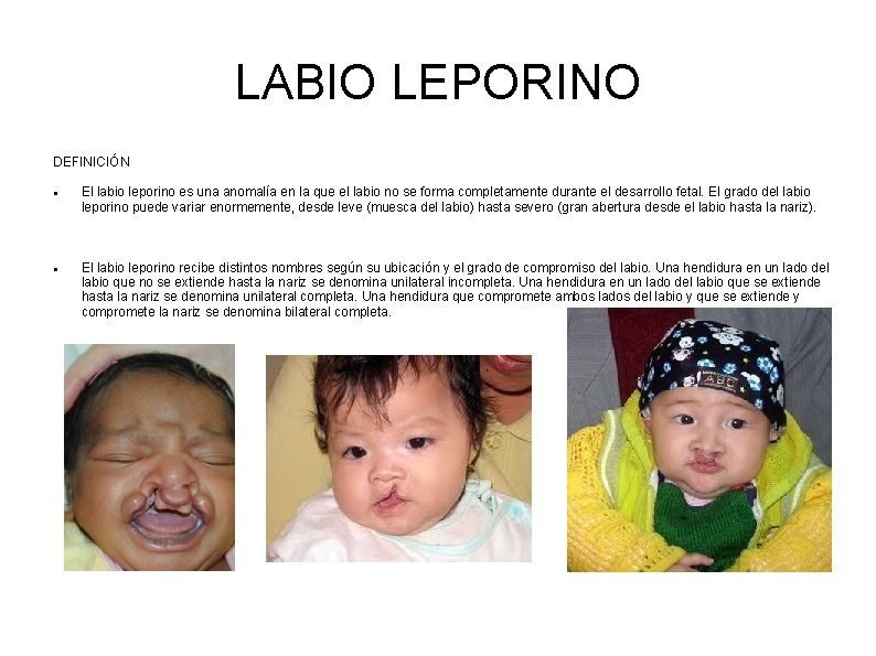 LABIO LEPORINO DEFINICIÓN El labio leporino es una anomalía en la que el labio