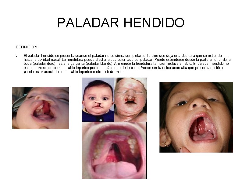 PALADAR HENDIDO DEFINICIÓN El paladar hendido se presenta cuando el paladar no se cierra PALADAR HENDIDO DEFINICIÓN El paladar hendido se presenta cuando el paladar no se cierra