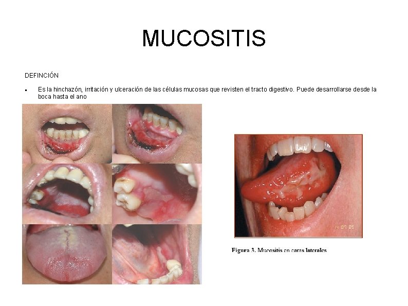 MUCOSITIS DEFINCIÓN Es la hinchazón, irritación y ulceración de las células mucosas que revisten