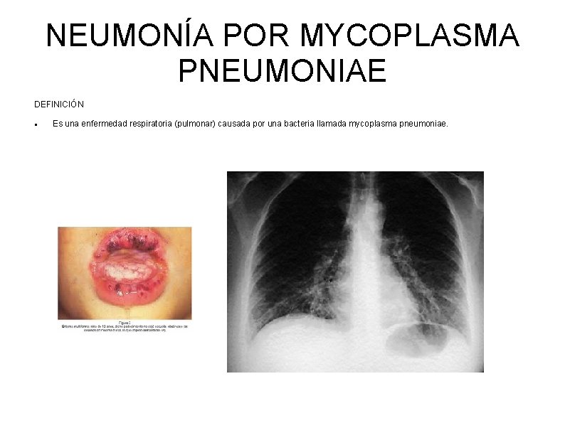 NEUMONÍA POR MYCOPLASMA PNEUMONIAE DEFINICIÓN Es una enfermedad respiratoria (pulmonar) causada por una bacteria