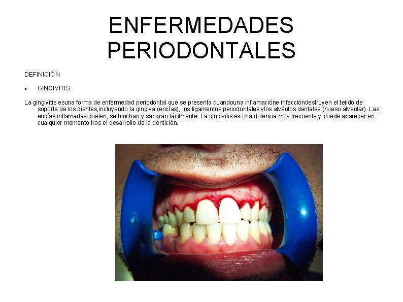 ENFERMEDADES PERIODONTALES DEFINICIÓN GINGIVITIS La gingivitis esuna forma de enfermedad periodontal que se presenta