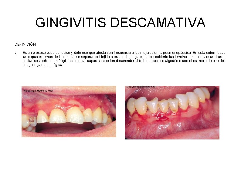 GINGIVITIS DESCAMATIVA DEFINICIÓN Es un proceso poco conocido y doloroso que afecta con frecuencia