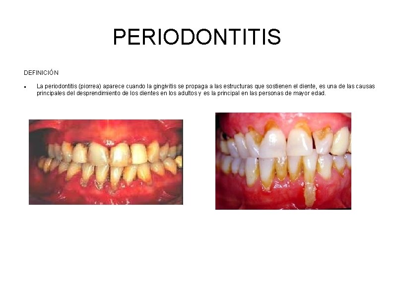 PERIODONTITIS DEFINICIÓN La periodontitis (piorrea) aparece cuando la gingivitis se propaga a las estructuras