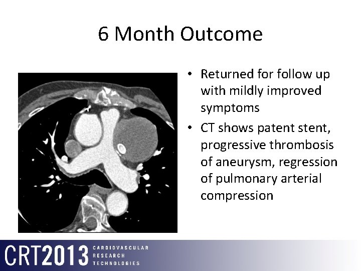 6 Month Outcome • Returned for follow up with mildly improved symptoms • CT