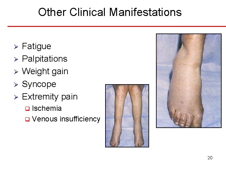 Other Clinical Manifestations Ø Ø Ø Fatigue Palpitations Weight gain Syncope Extremity pain Ischemia