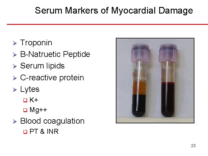 Serum Markers of Myocardial Damage Ø Ø Ø Troponin B-Natruetic Peptide Serum lipids C-reactive