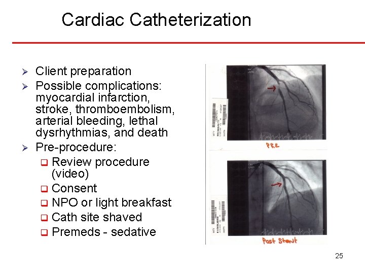 Cardiac Catheterization Ø Ø Ø Client preparation Possible complications: myocardial infarction, stroke, thromboembolism, arterial