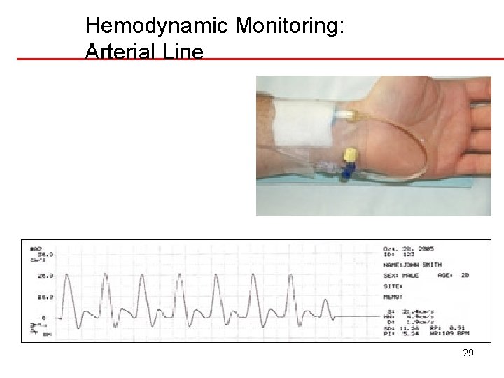 Hemodynamic Monitoring: Arterial Line 29 