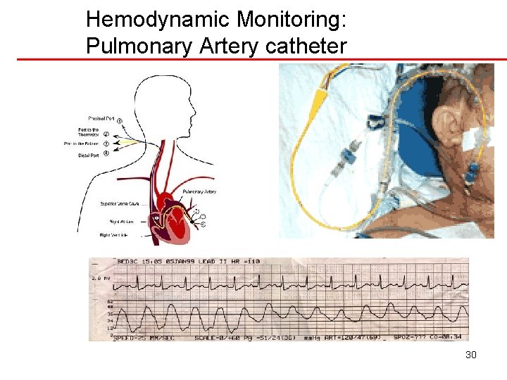 Hemodynamic Monitoring: Pulmonary Artery catheter 30 