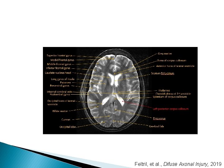 Feltril, et al. , Difuse Axonal Injury, 2019 