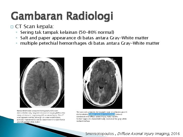 Gambaran Radiologi � CT Scan kepala: ◦ Sering tak tampak kelainan (50 -80% normal)
