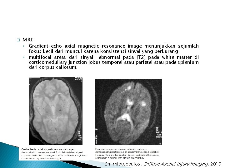 � MRI: ◦ Gradient-echo axial magnetic resonance image menunjukkan sejumlah fokus kecil dari muncul