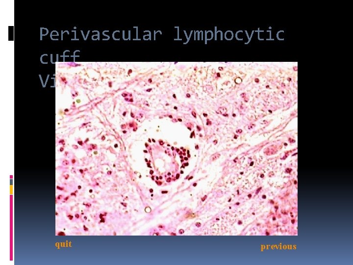 Perivascular lymphocytic cuff Viral encephalitis quit previous 