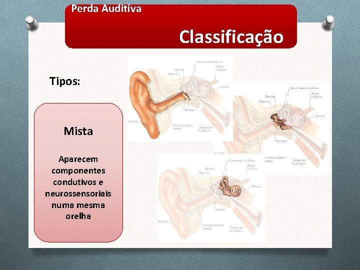 Perda Auditiva Classificação Tipos: Mista Aparecem componentes condutivos e neurossensoriais numa mesma orelha 