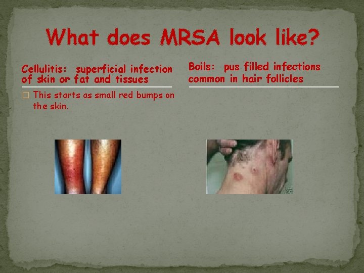 What does MRSA look like? Cellulitis: superficial infection of skin or fat and tissues