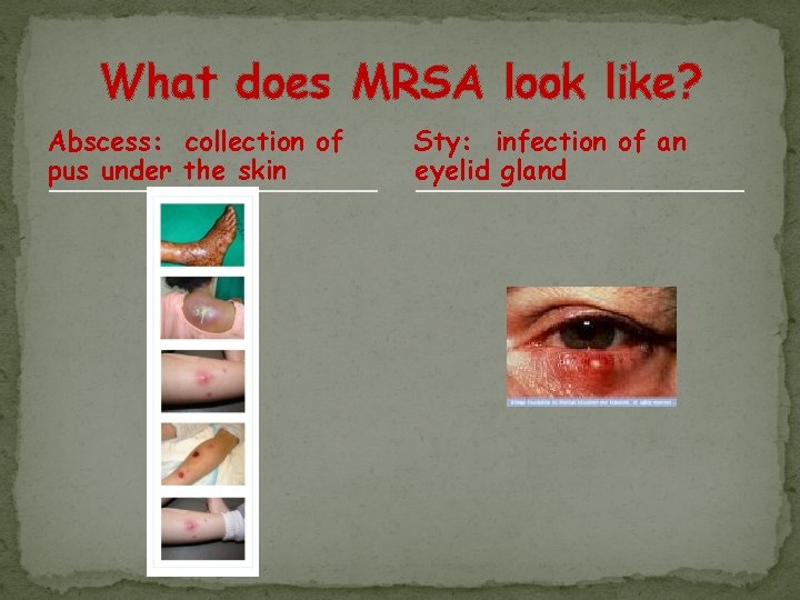 What does MRSA look like? Abscess: collection of pus under the skin Sty: infection