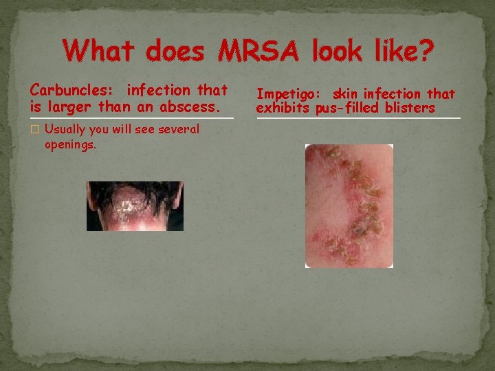 What does MRSA look like? Carbuncles: infection that is larger than an abscess. �