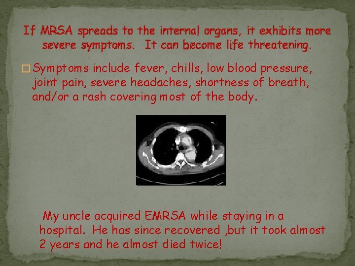 If MRSA spreads to the internal organs, it exhibits more severe symptoms. It can