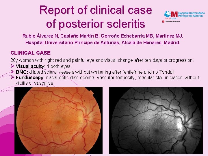 Report of clinical case of posterior scleritis Rubio Álvarez N, Castaño Martín B, Gorroño