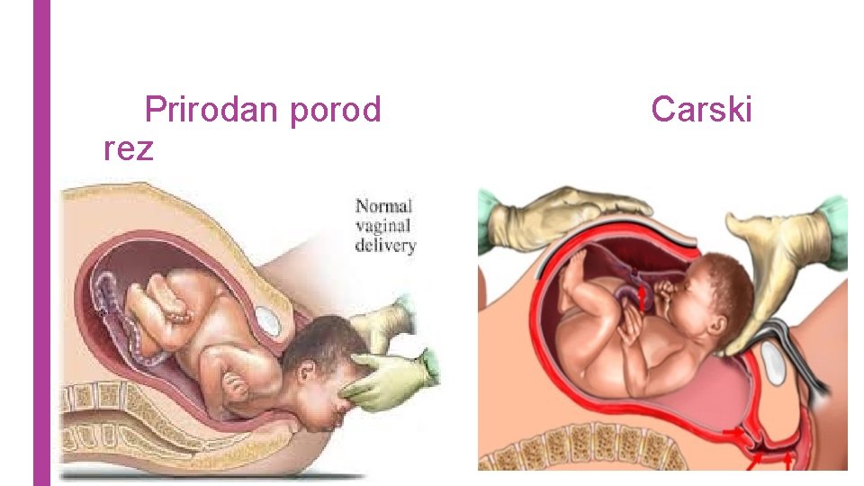 Prirodan porod rez Carski 