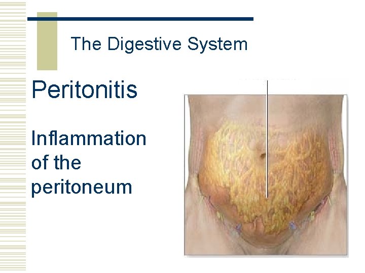 The Digestive System Peritonitis Inflammation of the peritoneum 