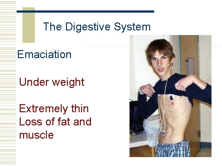 The Digestive System Emaciation Under weight Extremely thin Loss of fat and muscle 
