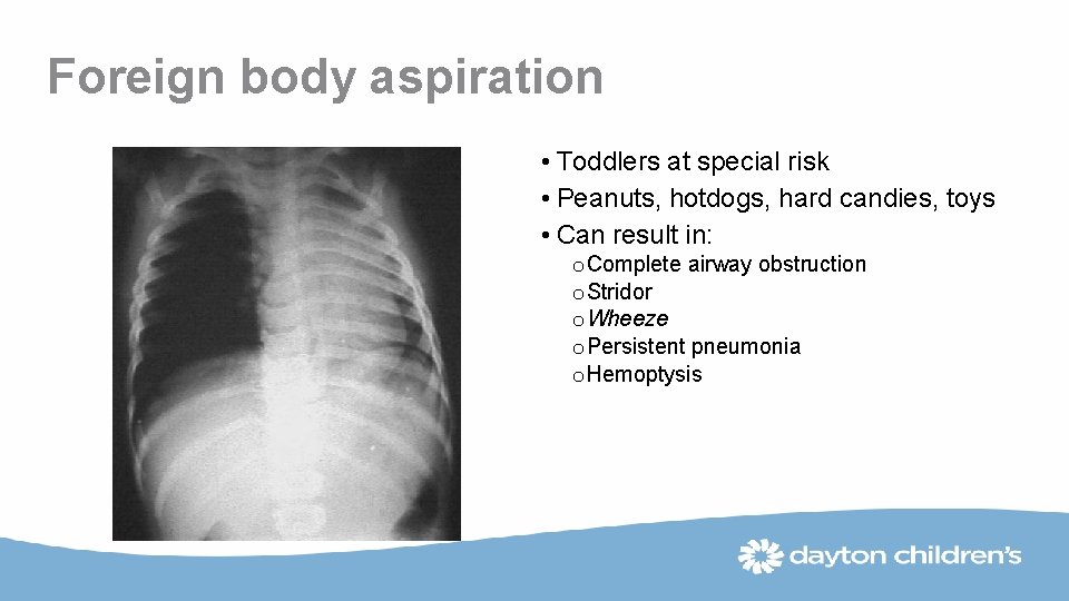 Foreign body aspiration • Toddlers at special risk • Peanuts, hotdogs, hard candies, toys