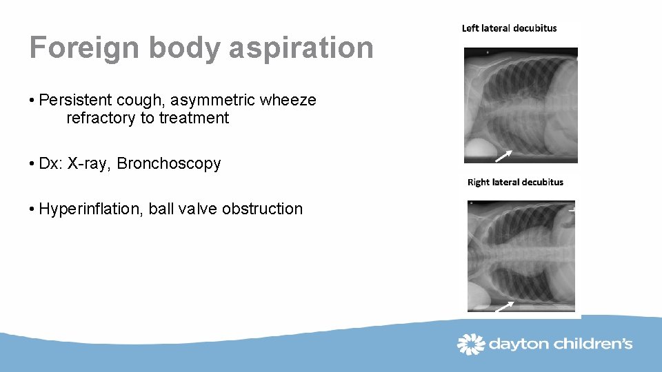 Foreign body aspiration • Persistent cough, asymmetric wheeze refractory to treatment • Dx: X-ray,