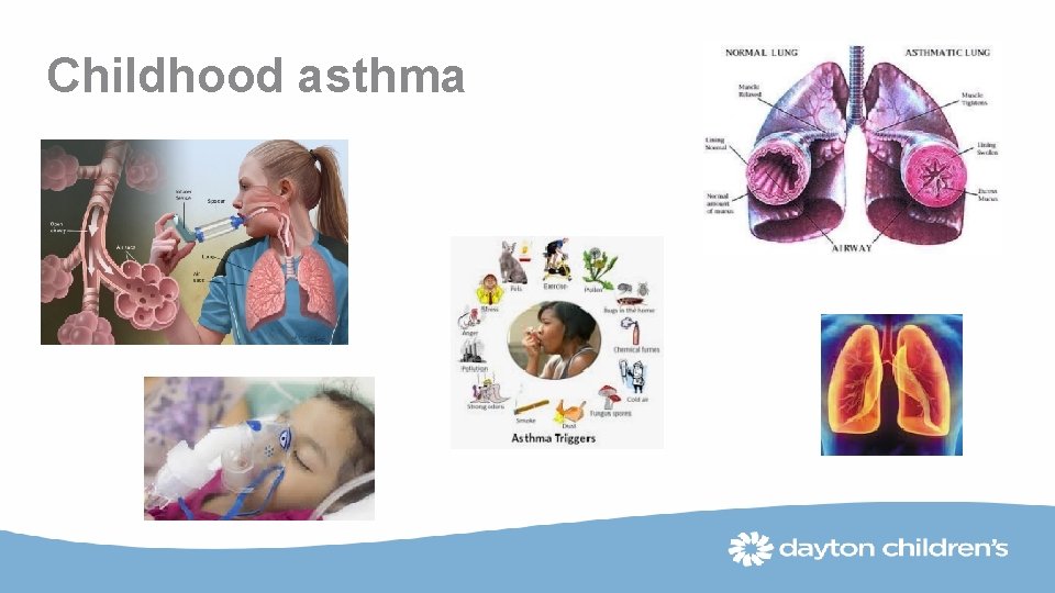 Childhood asthma 