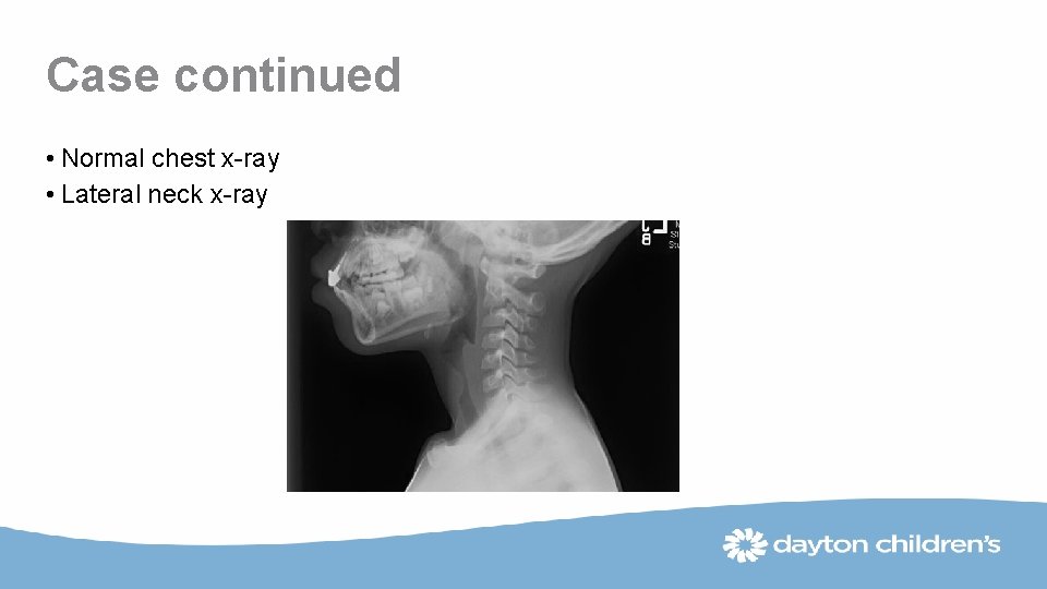 Case continued • Normal chest x-ray • Lateral neck x-ray 