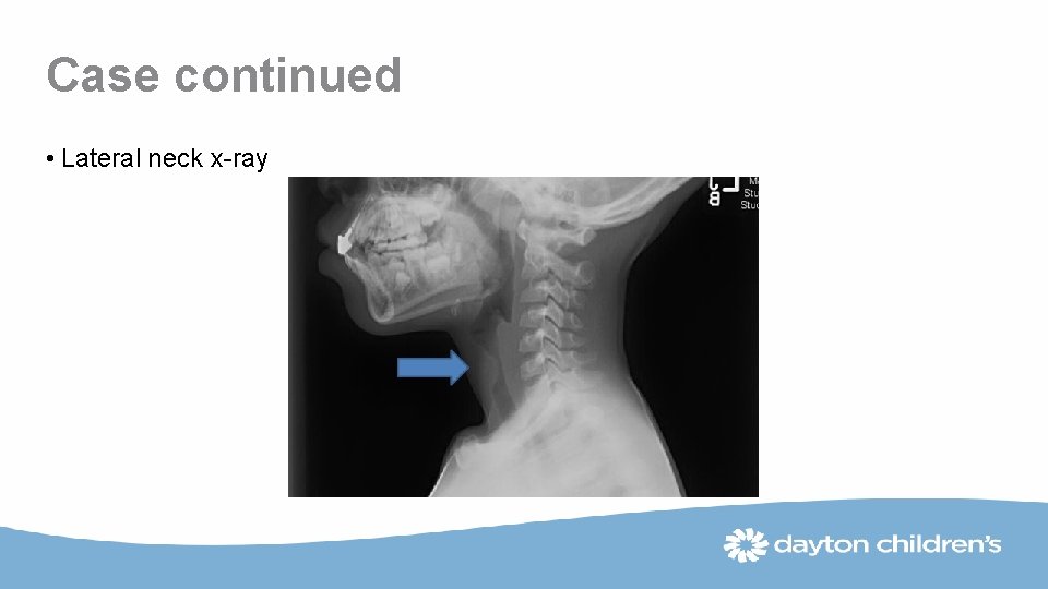 Case continued • Lateral neck x-ray 