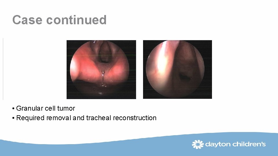 Case continued • Granular cell tumor • Required removal and tracheal reconstruction 