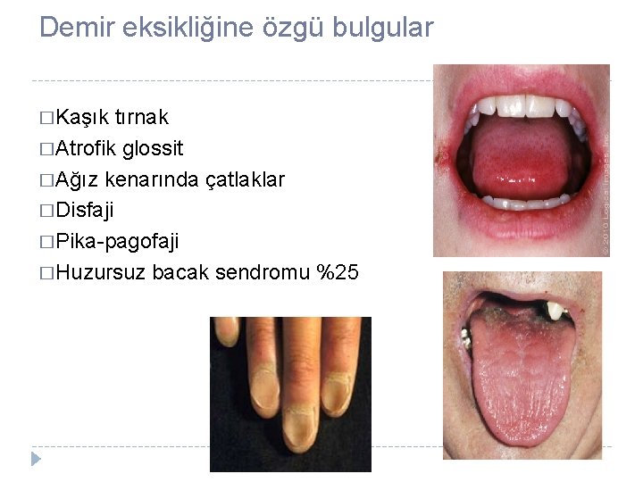 Demir eksikliğine özgü bulgular �Kaşık tırnak �Atrofik glossit �Ağız kenarında çatlaklar �Disfaji �Pika-pagofaji �Huzursuz