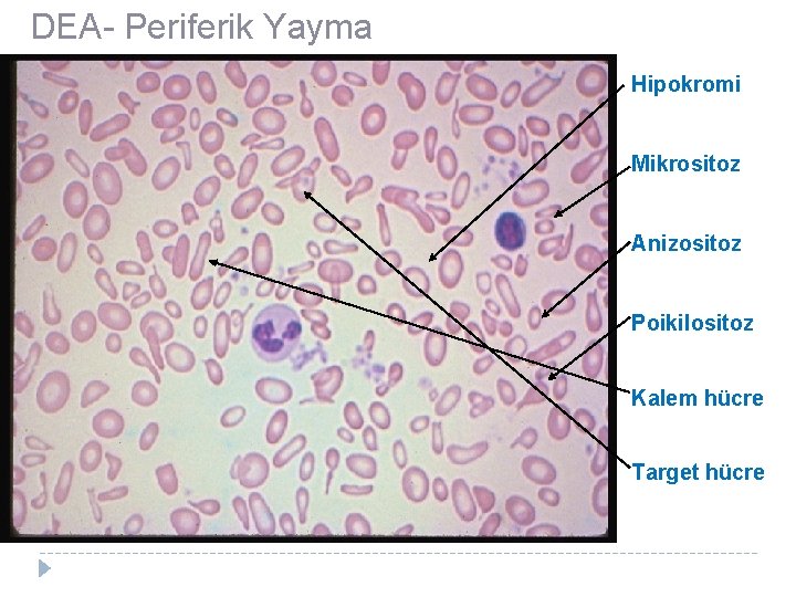 DEA- Periferik Yayma Hipokromi Mikrositoz Anizositoz Poikilositoz Kalem hücre Target hücre 