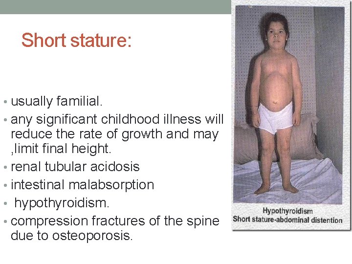 Short stature: • usually familial. • any significant childhood illness will reduce the rate