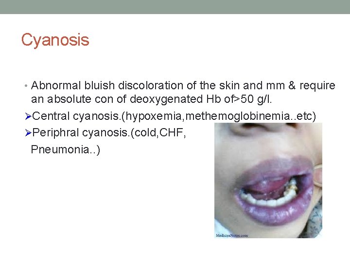 Cyanosis • Abnormal bluish discoloration of the skin and mm & require an absolute