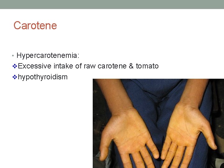 Carotene • Hypercarotenemia: v. Excessive intake of raw carotene & tomato vhypothyroidism 