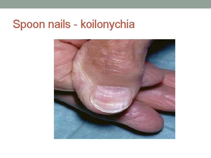 Spoon nails - koilonychia 