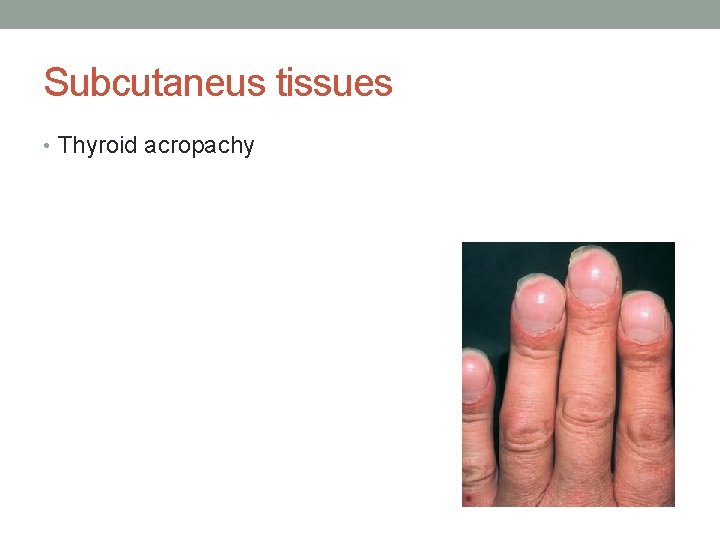 Subcutaneus tissues • Thyroid acropachy 