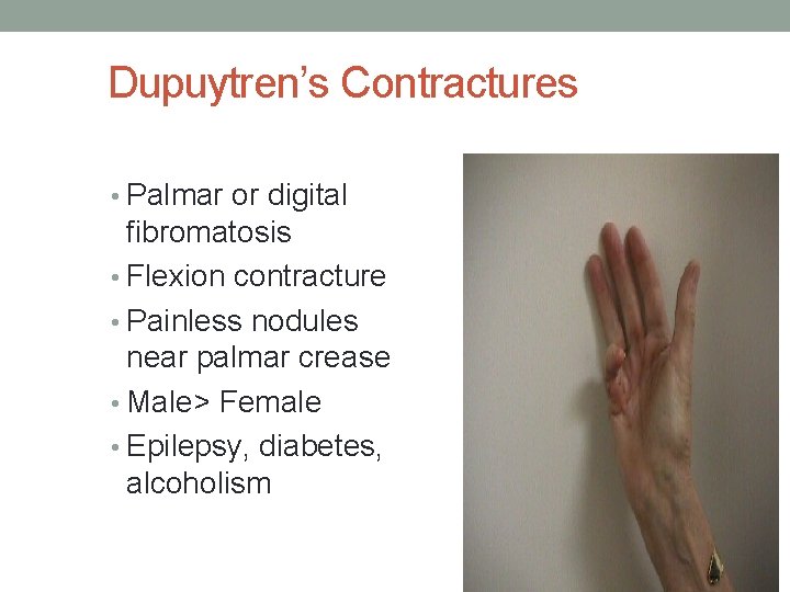 Dupuytren’s Contractures • Palmar or digital fibromatosis • Flexion contracture • Painless nodules near