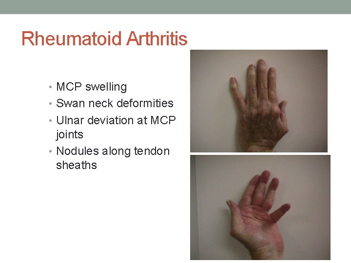 Rheumatoid Arthritis • MCP swelling • Swan neck deformities • Ulnar deviation at MCP