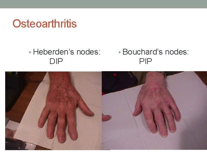 Osteoarthritis • Heberden’s nodes: DIP • Bouchard’s nodes: PIP 