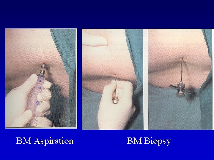 BM Aspiration BM Biopsy 