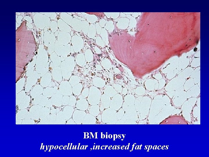 BM biopsy hypocellular , increased fat spaces 